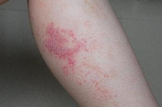 皮肤瘙痒有哪些具体症状